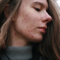 acne